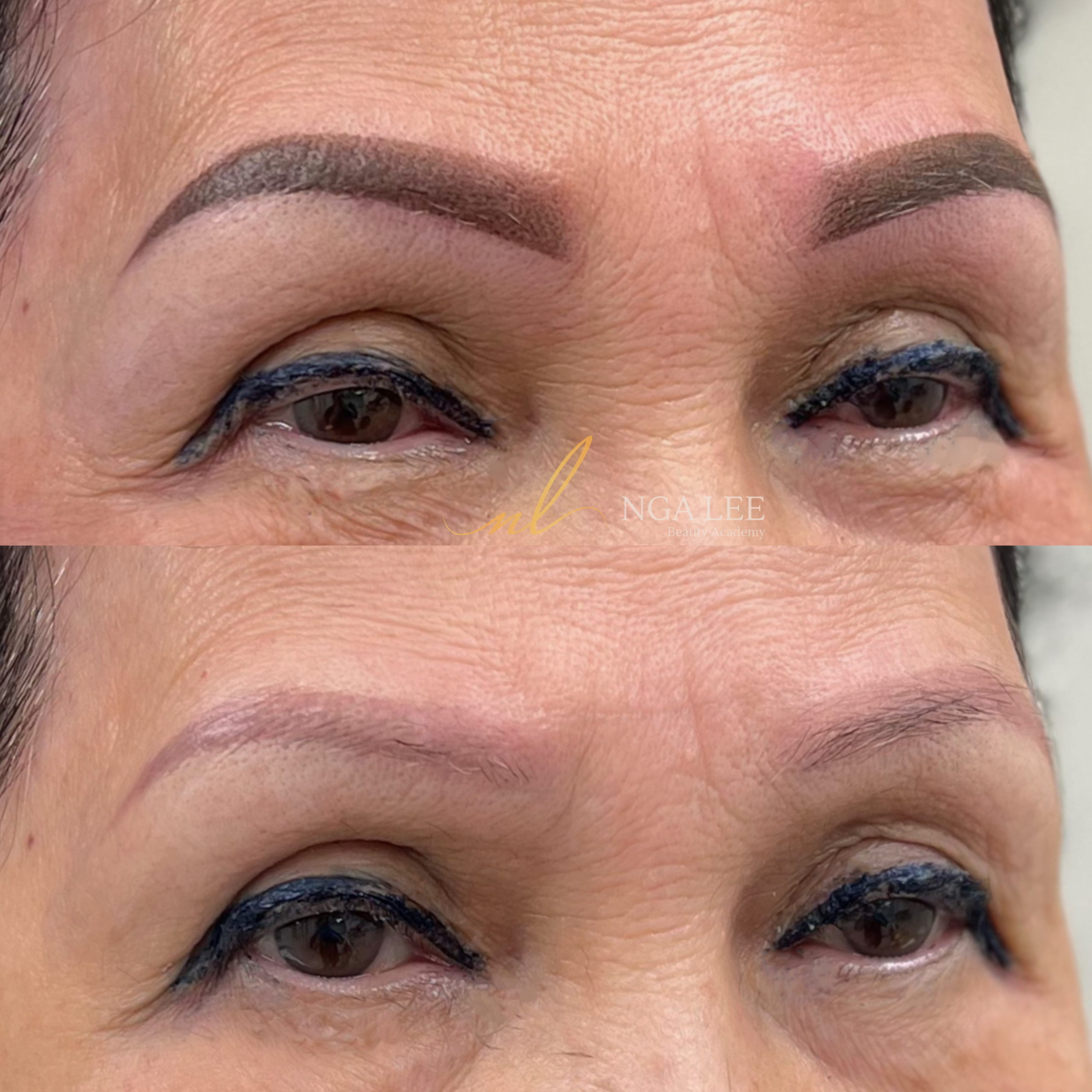 Corrective Brow